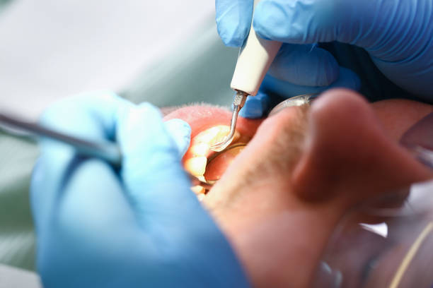 Best Emergency Tooth Extraction in Tarkio, MO