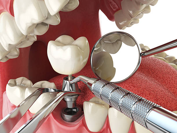 Best Emergency Treatment for Dental Infections or Abscesses in Tarkio, MO